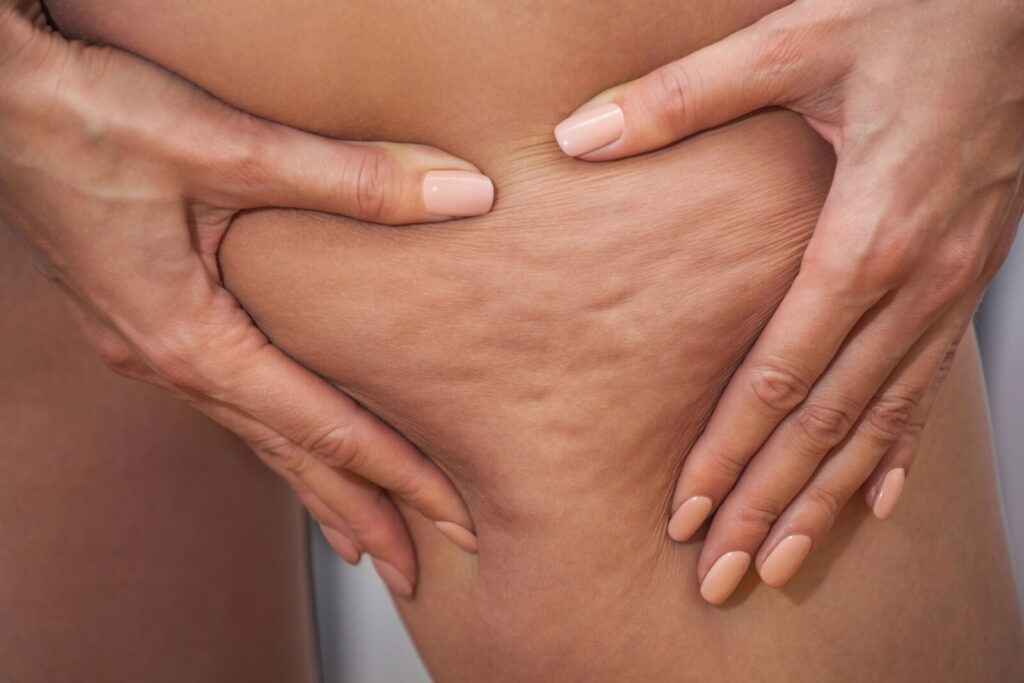 drainage lymphatique et cellulite - traitement Arcachon – Traitement de la cellulite par drainage lymphatique